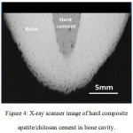 Figure 4: X-ray scanner image of hard composite apatite/chitosan cement in bone cavity.